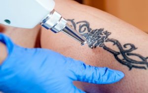 Top 7 Ways to Improve Your Tattoo Removal