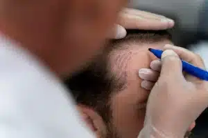 Comparing FUE and FUT: How These Hair Transplant Techniques Differ
