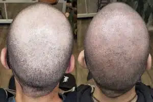 Scalp micropigmentation suitability assessment for different skin types
