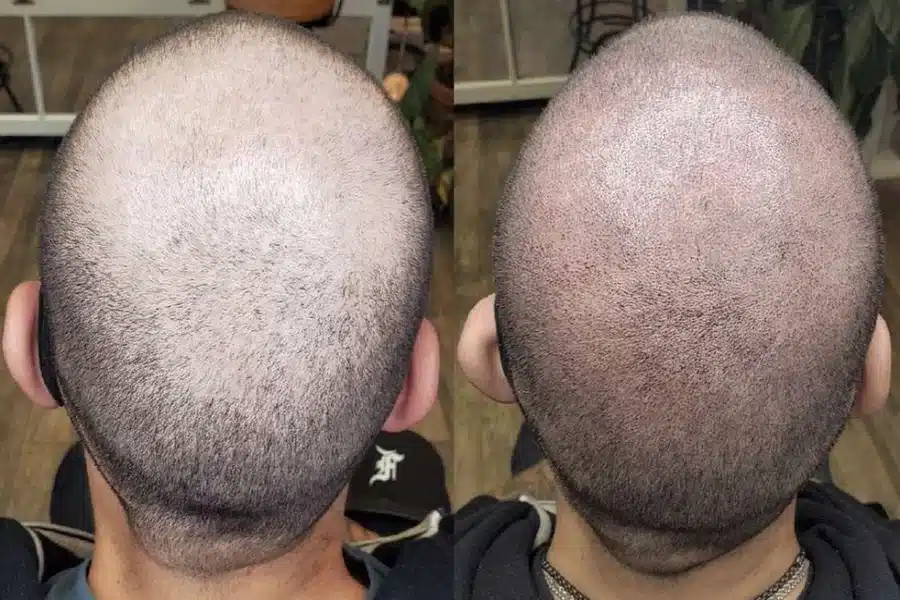 Scalp micropigmentation