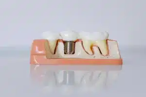 Factors That Influence the Cost of a Tooth Implant
