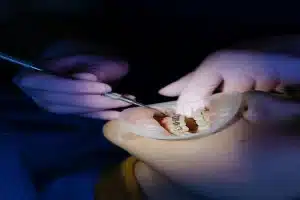 Types of Braces Available in New City NY