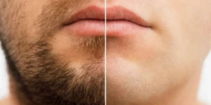 How to Remove Beard from a Photo for Clean and Natural Portrait Edits