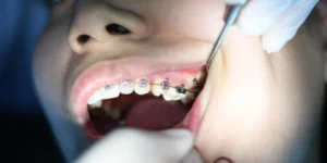 Top Tips for Dental Emergencies: What You Need to Know