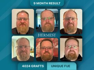 Hermest Hair Clinic Before and After Results: What 17,000 Procedures and 99% Graft Survival Actually Look Like