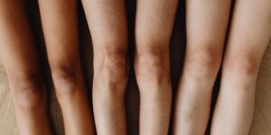 Managing Knee Osteoarthritis in Active Adults: Comparing High-Molecular-Weight Viscosupplementation to Steroid Injections