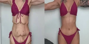 Mini, Full, Extended or Fleur-de-Lis: Choosing the Abdominoplasty Your Body Actually Needs