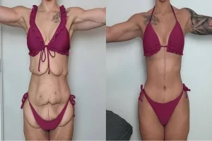 Mini, Full, Extended or Fleur-de-Lis: Choosing the Abdominoplasty Your Body Actually Needs
