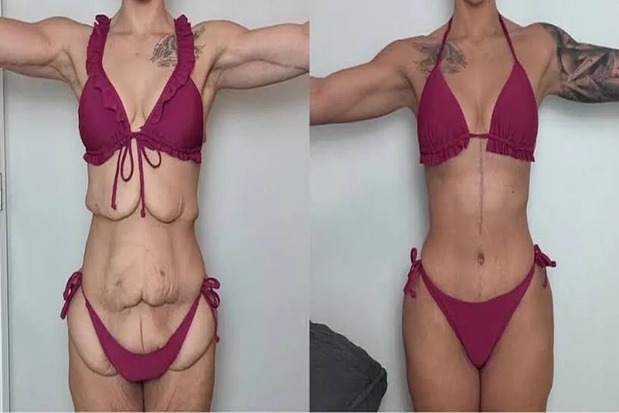 Abdominoplasty