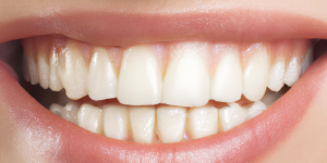 Root Causes of Enamel Wear and Modern Clinical Interventions – Markham Smile Centre