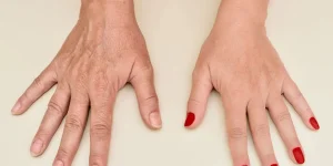 Hands Tell Your Age: Wrinkles in Ring Shots and Close-Ups