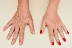 Hands Tell Your Age: Wrinkles in Ring Shots and Close-Ups