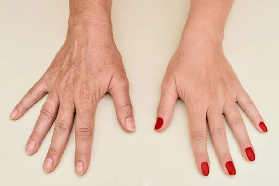 Hands Tell Your Age: Wrinkles in Ring Shots and Close-Ups
